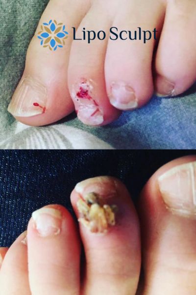Wart removal customer results from Lipo Sculpt East Kilbride